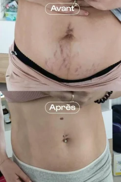 Discount Omum Concentré correcteur vergetures L’Expert