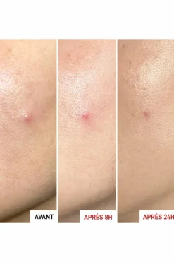 Hot Erborian Gel effet patch anti-imperfections Centella SOS Patch