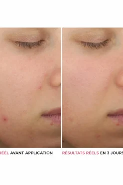 it Cosmetics Sérum anti-acné à l’acide salicylique Bye Bye Serum